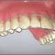 removable-clear-aligner-when-it-is-worn