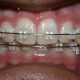 clear-braces