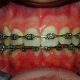fixed-braces