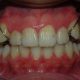 removable-braces