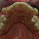 removable-braces-top-view